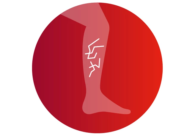 Venenschwäche Symptom Besenreiser